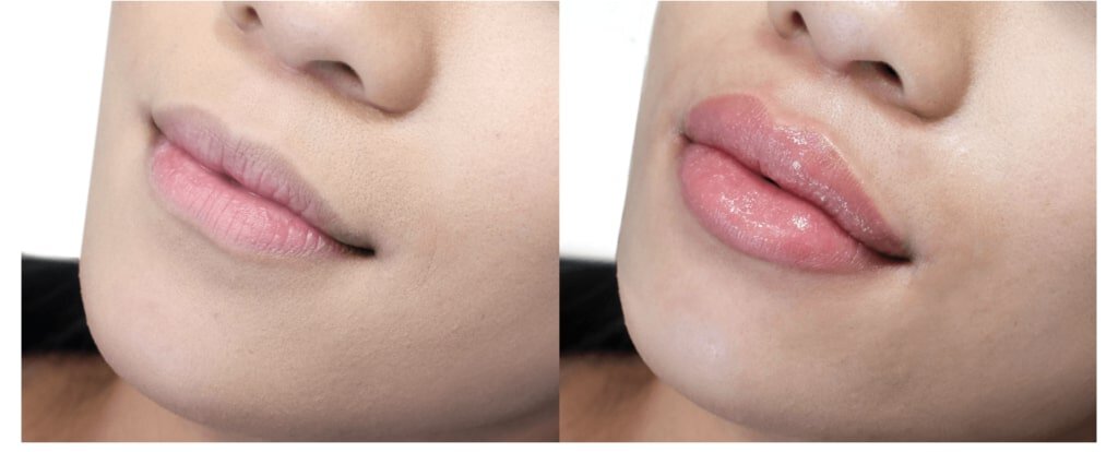 Lubbock Lip Filler before and after