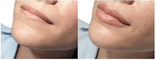 Lubbock Lip Filler before and after