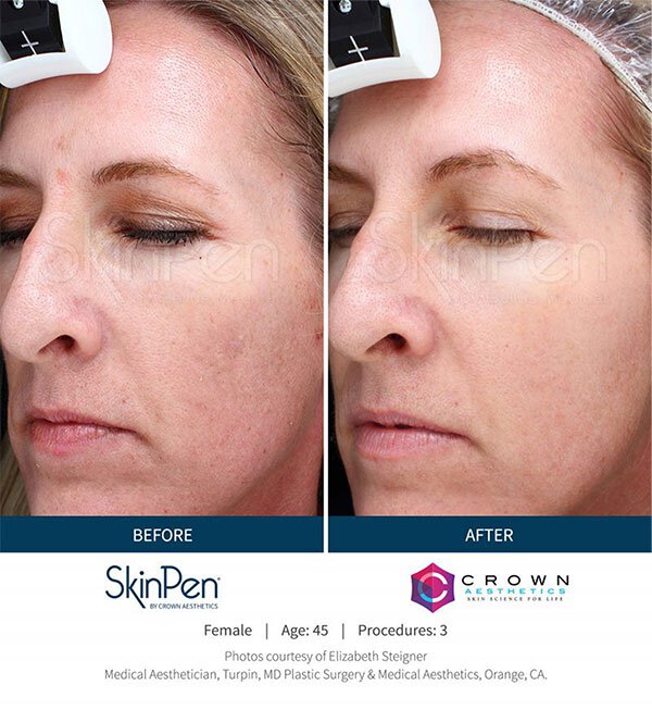 Lubbock SkinPen Microneedling before and after