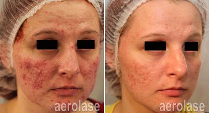 Acne Treatment Before & After Image