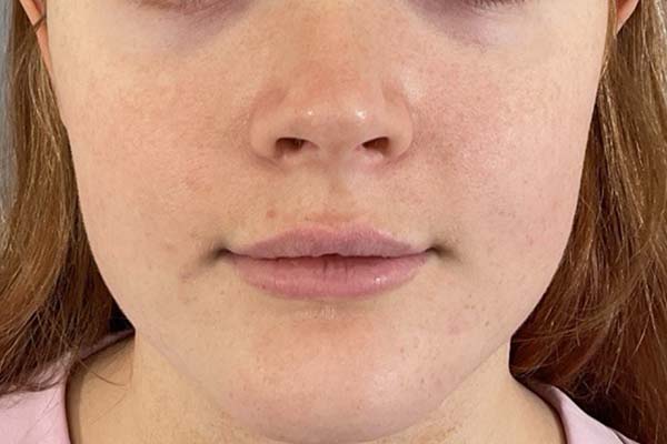 Emface Before & After Image