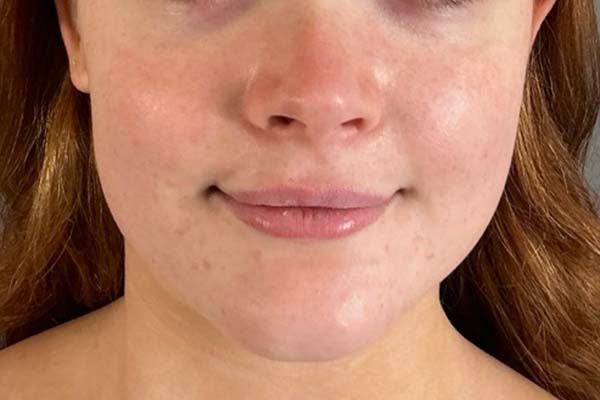 Emface Before & After Image