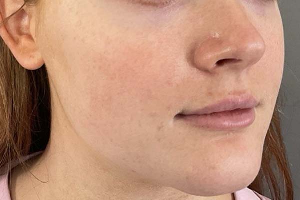 Emface Before & After Image