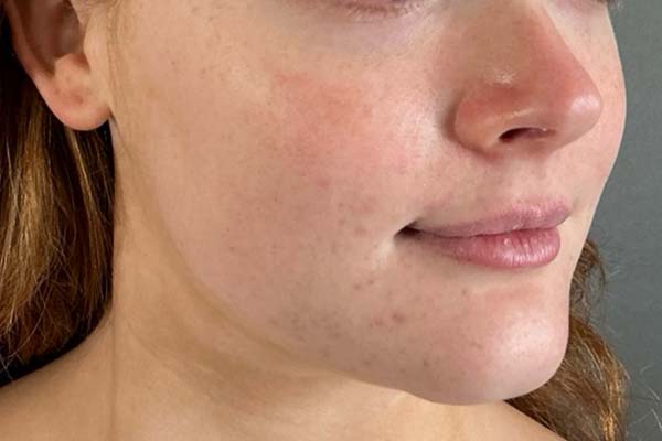 Emface Before & After Image