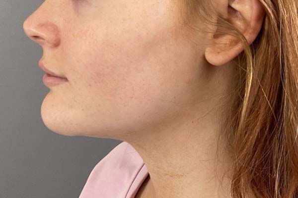 Emface Before & After Image