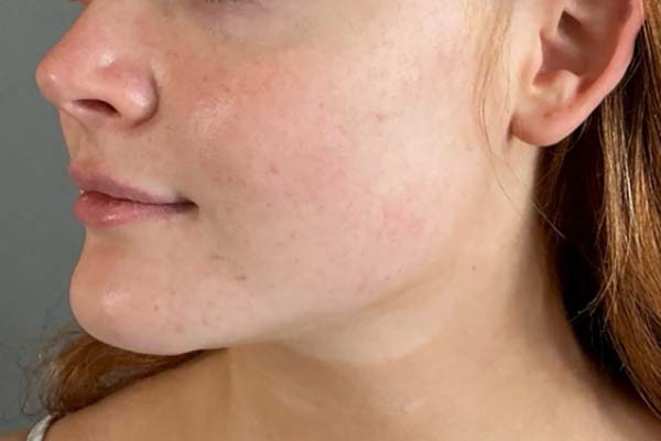 Emface Before & After Image