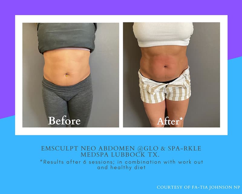 Emsculpt Neo Before & After Image