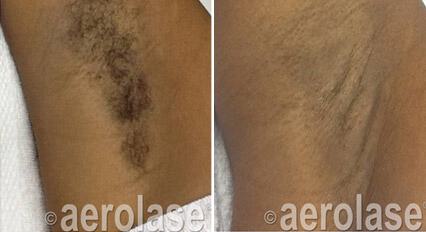 Hair Removal Before & After Image