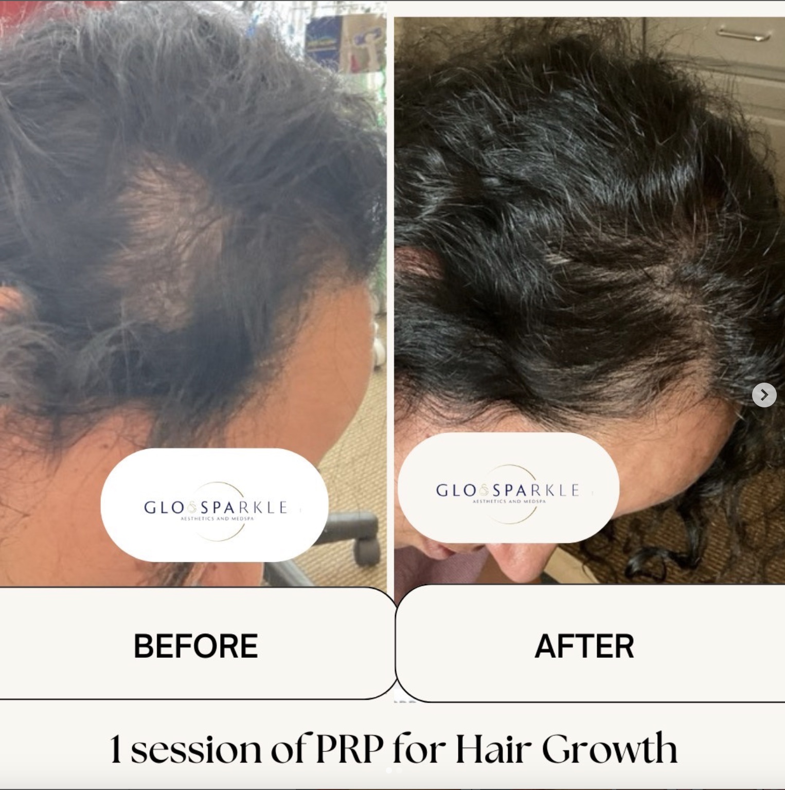 Hair Restoration With PRP Before & After Image