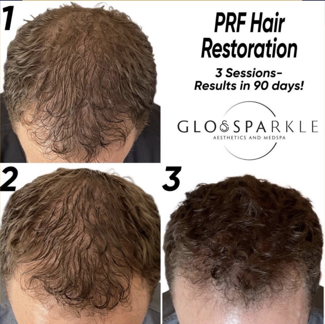 Hair Restoration With PRP Before & After Image