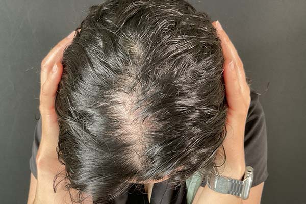 Hair Restoration With PRP Before & After Image