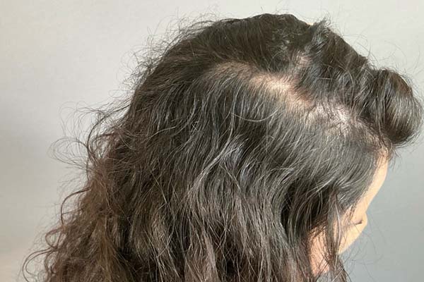 Hair Restoration With PRP Before & After Image