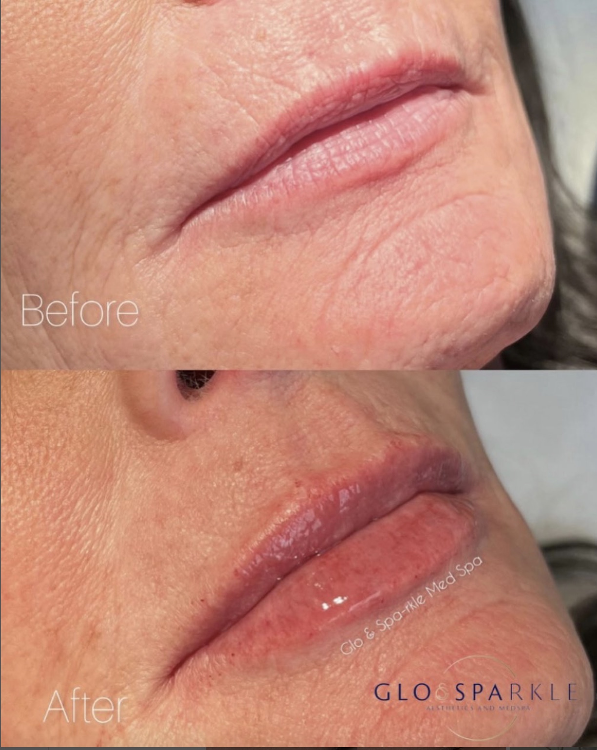 Lip Fillers Before & After Image