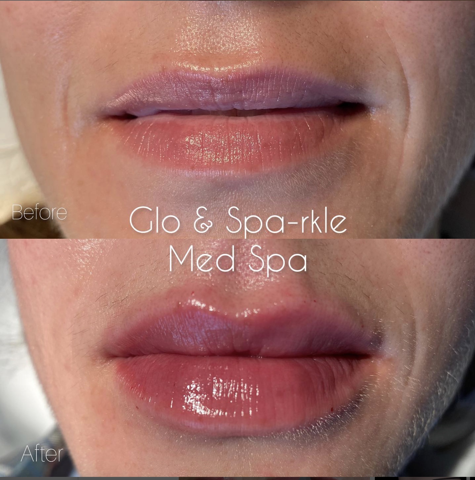 Lip Fillers Before & After Image