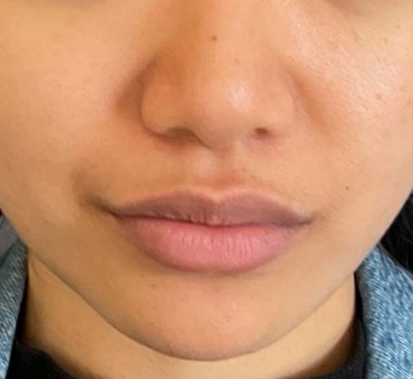 Lip fillers Before & After Image