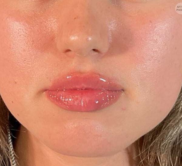Lip fillers Before & After Image