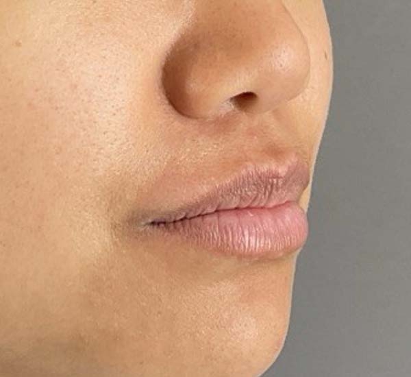 Lip fillers Before & After Image