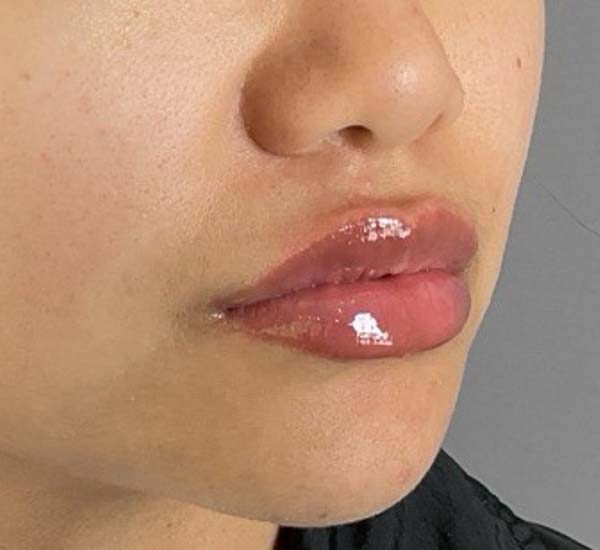 Lip fillers Before & After Image