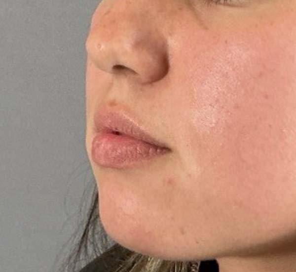 Lip Fillers Before & After Image