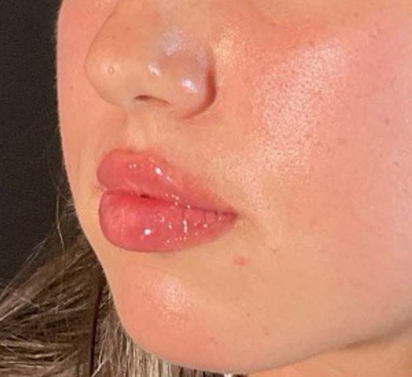Lip Fillers Before & After Image