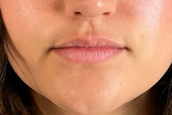 Lip fillers Before & After Image