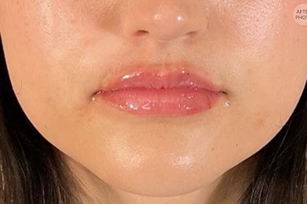 Lip fillers Before & After Image