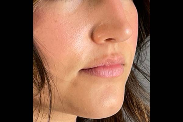 Lip fillers Before & After Image