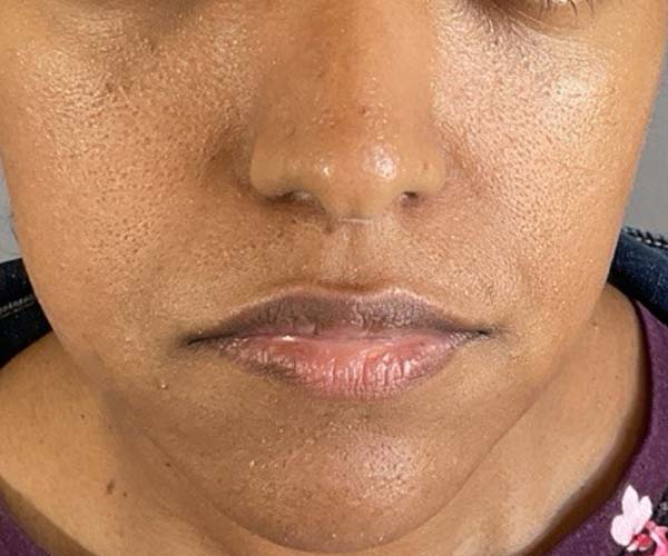 Lip fillers Before & After Image