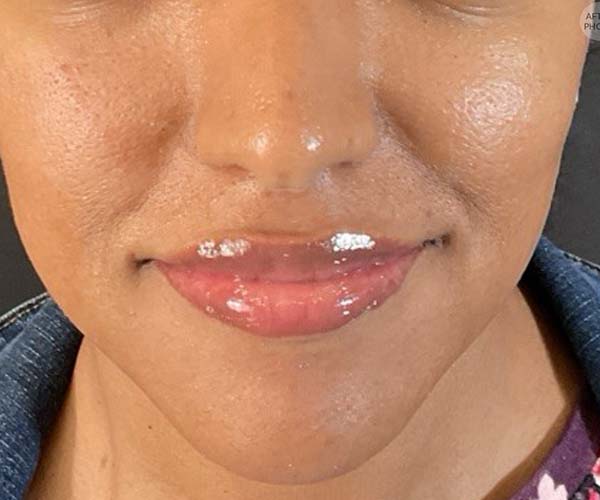 Lip fillers Before & After Image