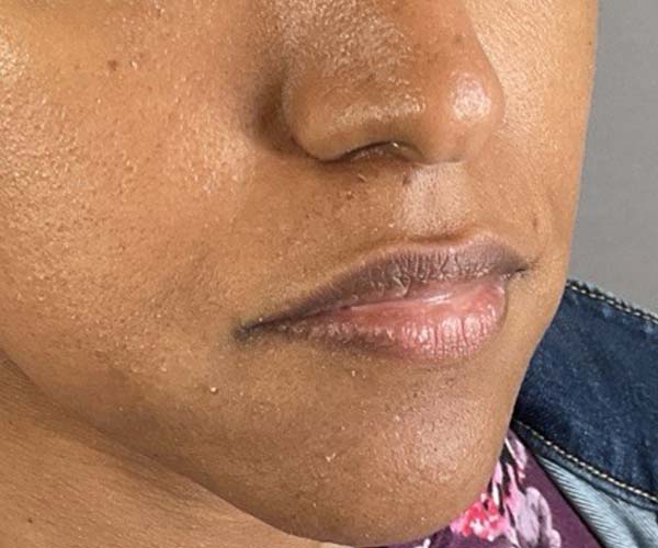 Lip fillers Before & After Image