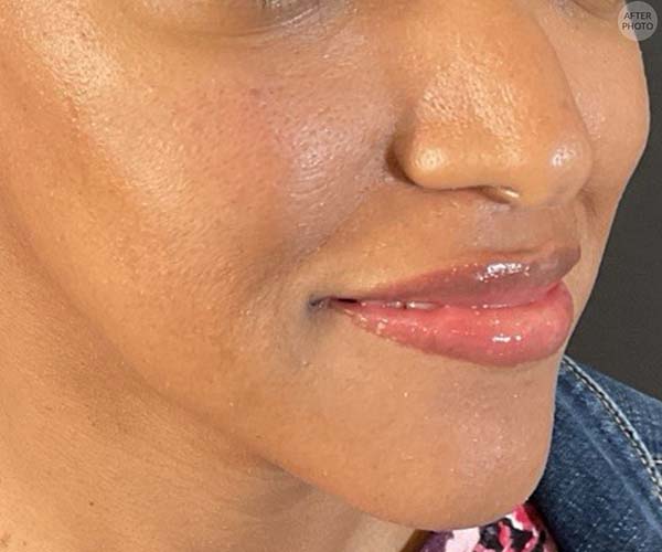 Lip fillers Before & After Image