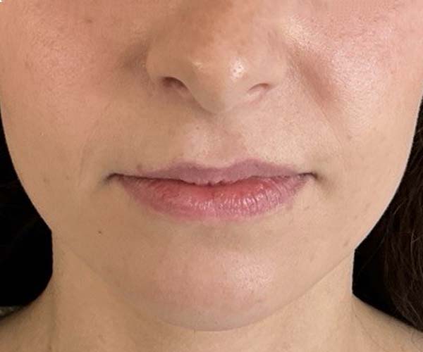 Lip fillers Before & After Image