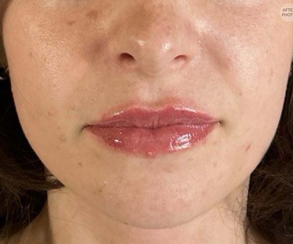 Lip fillers Before & After Image