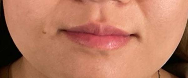 Lip fillers Before & After Image