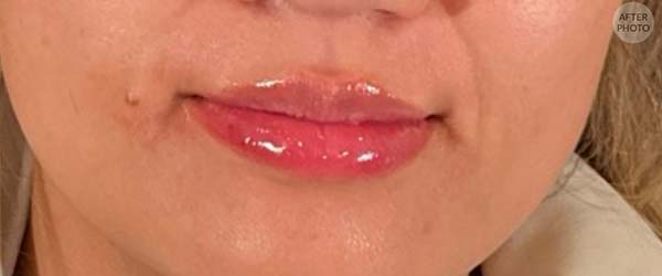 Lip fillers Before & After Image