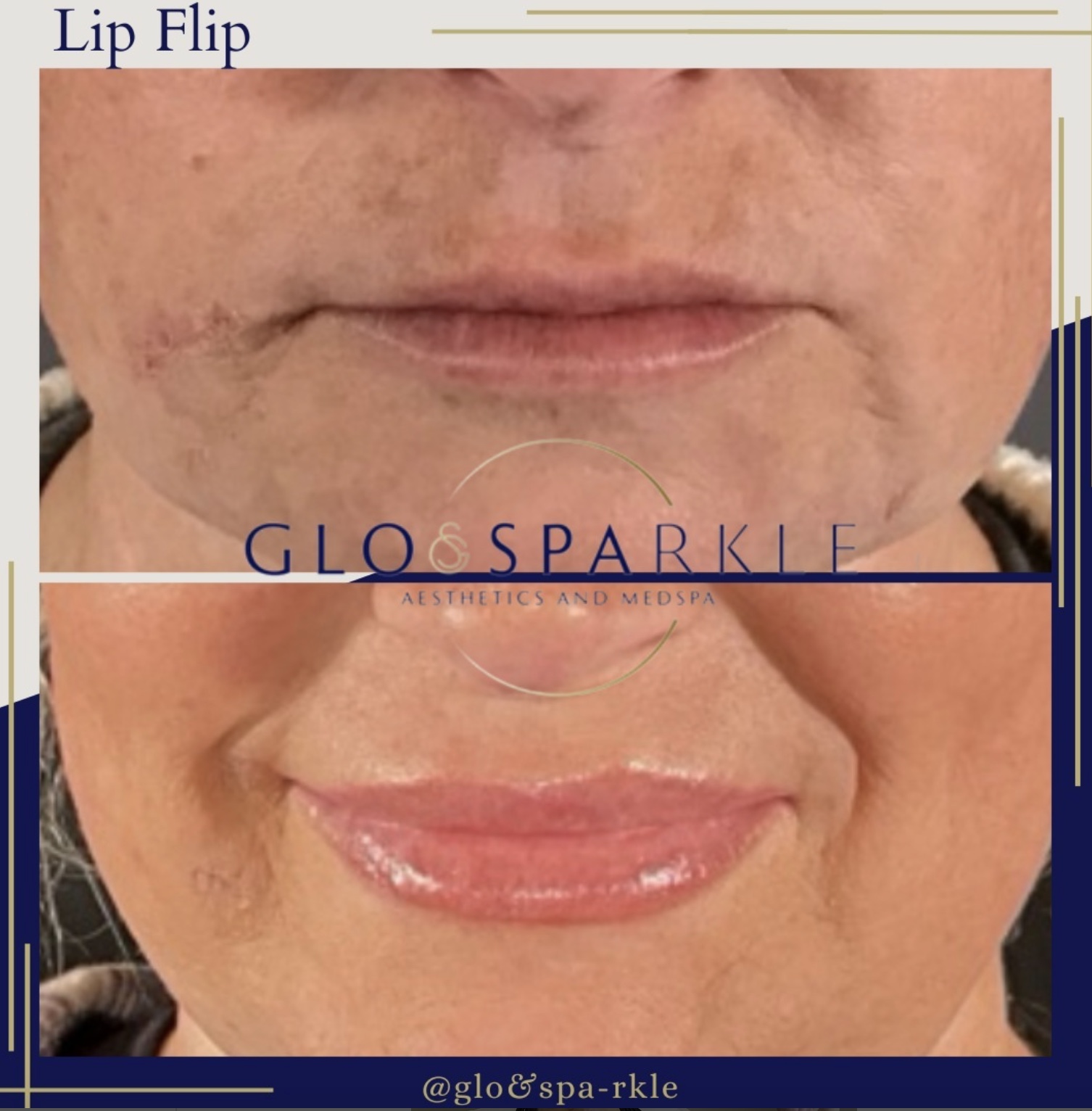 Lip Flip Before & After Image