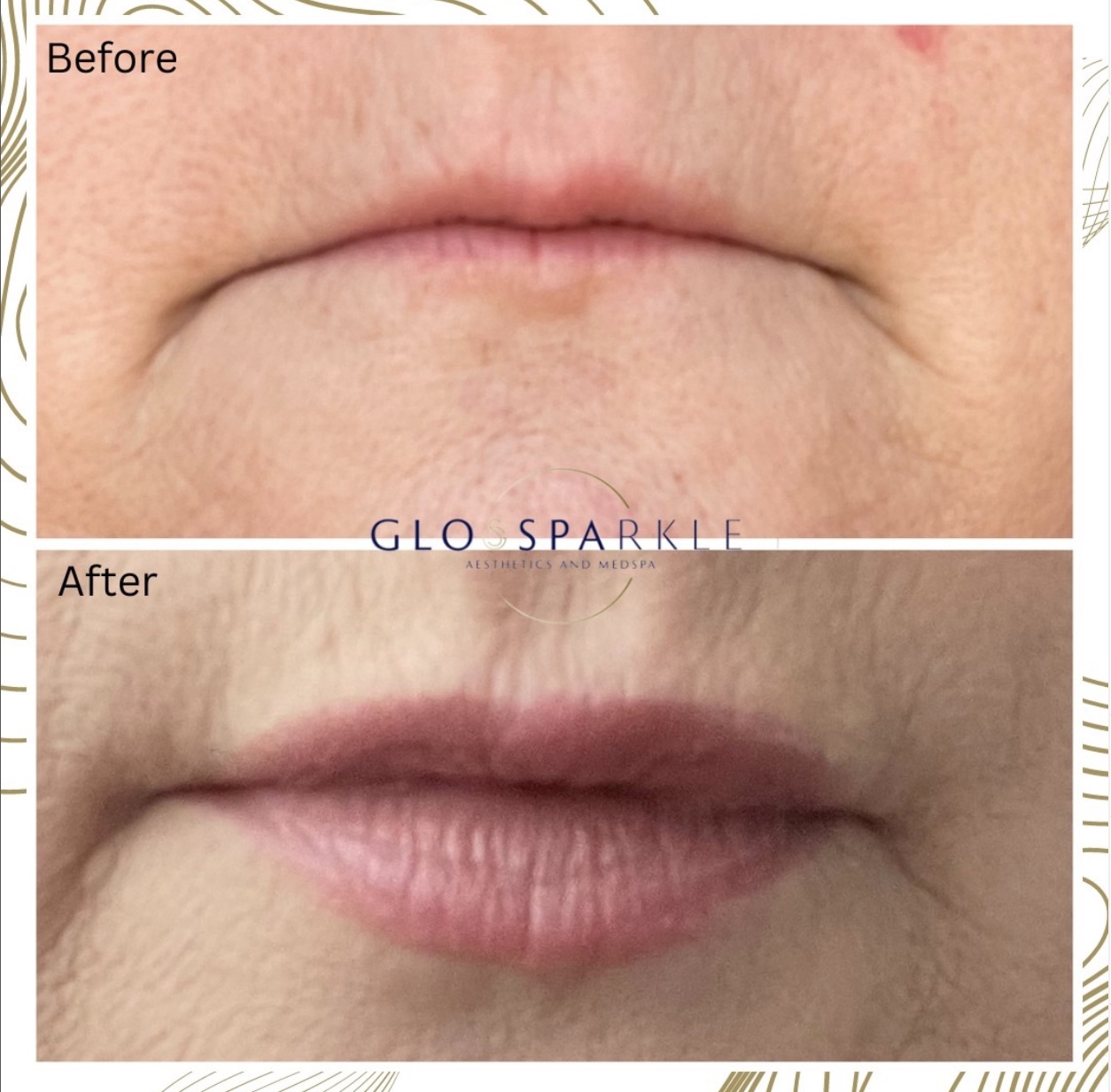 Lip Flip Before & After Image