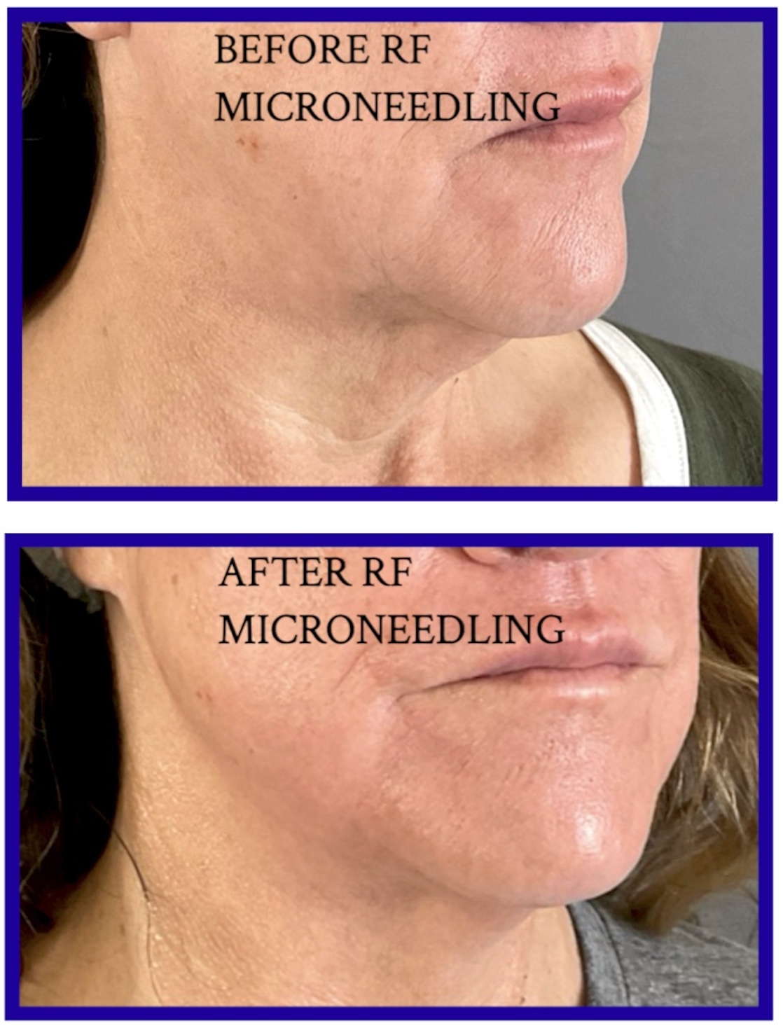 Microneedling Before & After Image