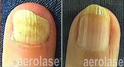 Nail Fungus Before & After Image