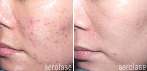 NeoClear Before & After Image
