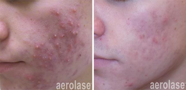 NeoClear Before & After Image