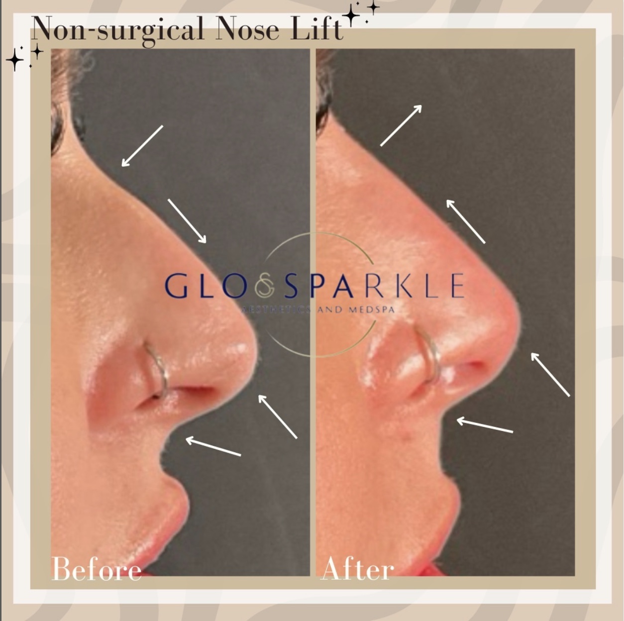 Non-Surgical Rhinoplasty Before & After Image