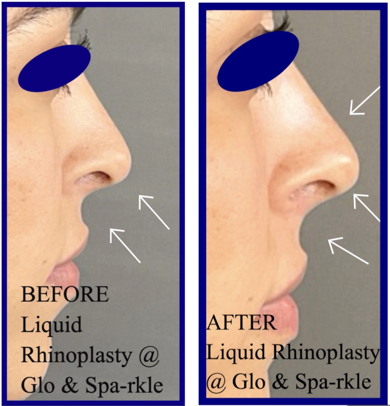 Non-Surgical Rhinoplasty Before & After Image