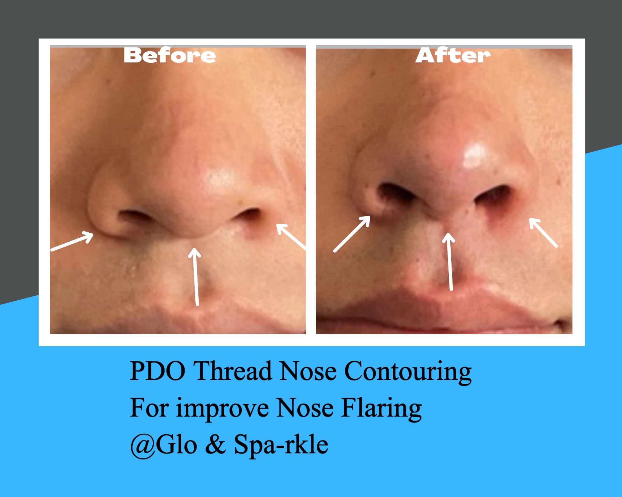 Non-Surgical Rhinoplasty Before & After Image