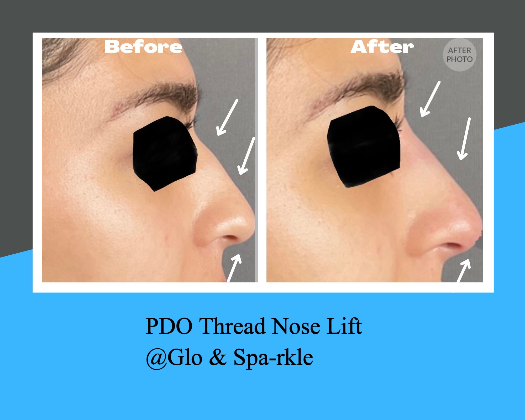 Non-Surgical Rhinoplasty Before & After Image