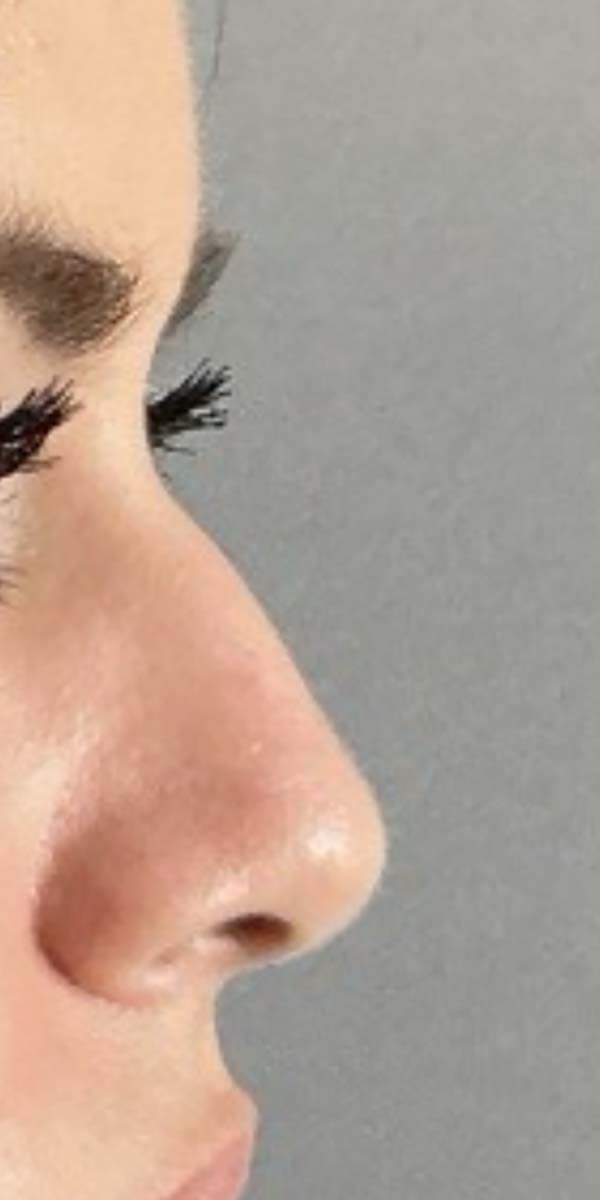 Non-Surgical Rhinoplasty Before & After Image