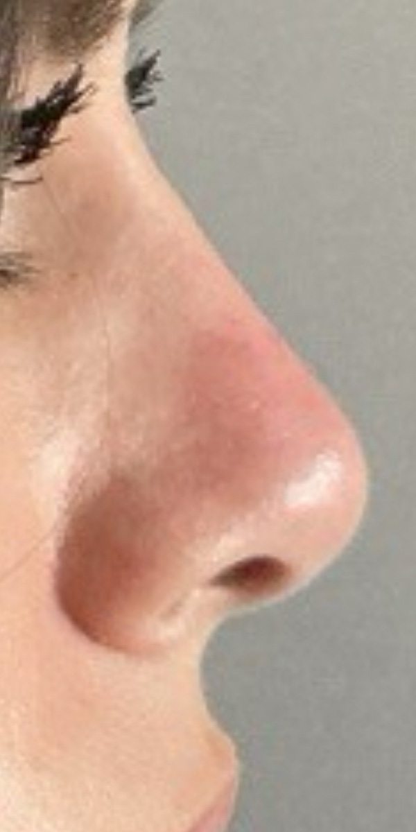 Non-Surgical Rhinoplasty Before & After Image