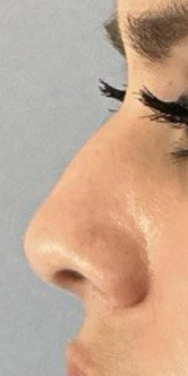 Non-Surgical Rhinoplasty Before & After Image