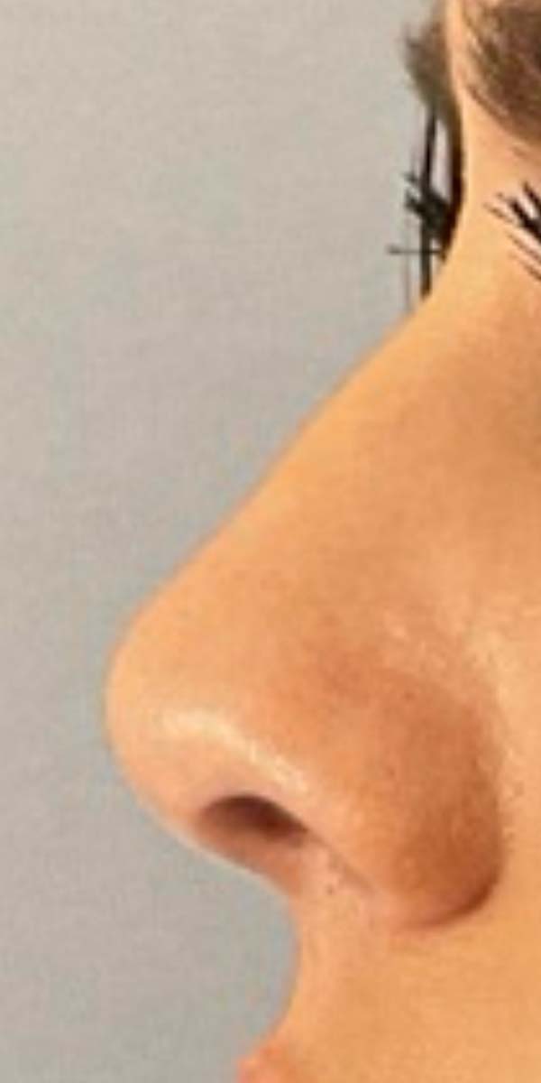 Non-Surgical Rhinoplasty Before & After Image
