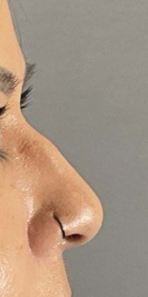 Non-Surgical Rhinoplasty Before & After Image